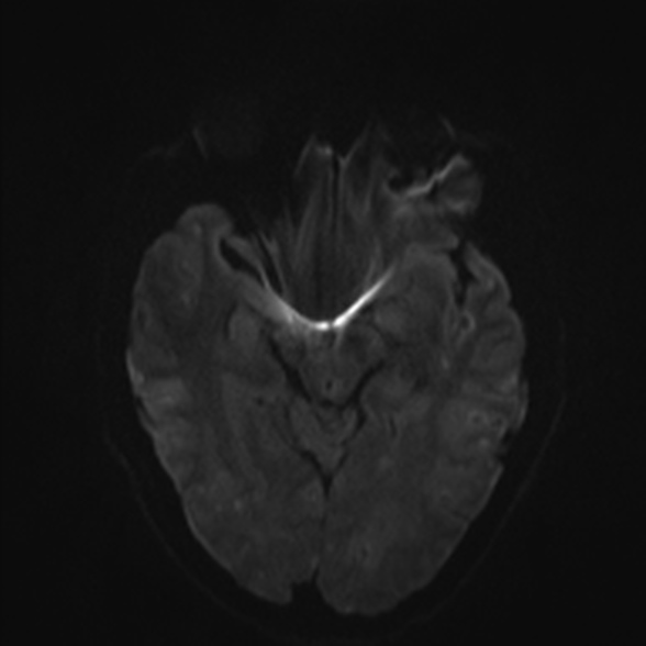 Cerebral toxoplasmosis (Radiopaedia 53993-60132 Axial DWI 38).jpg