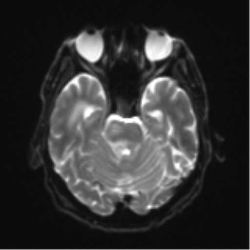 Cerebral toxoplasmosis (Radiopaedia 54575-60804 Axial DWI 12).png