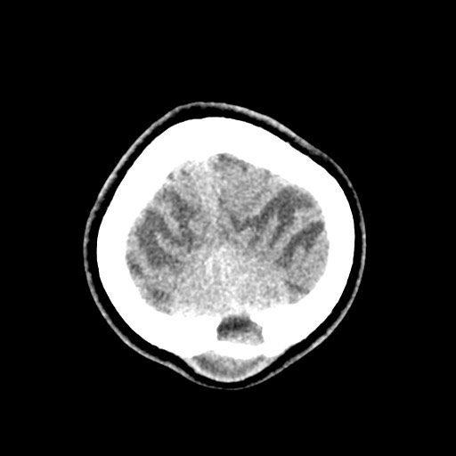 File:Cerebral tuberculosis with dural sinus invasion (Radiopaedia 60353-68018 Axial non-contrast 58).jpg