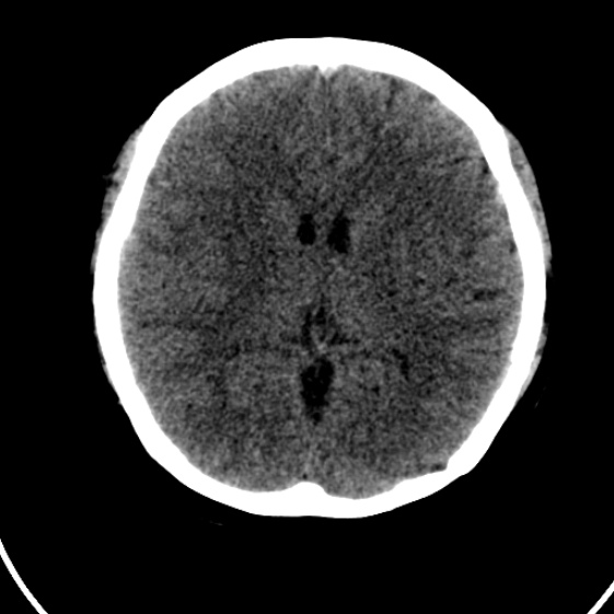 File:Cerebral venous hemorrhagic infarct from venous sinus thrombosis (Radiopaedia 55433-61879 Axial non-contrast 13).jpg