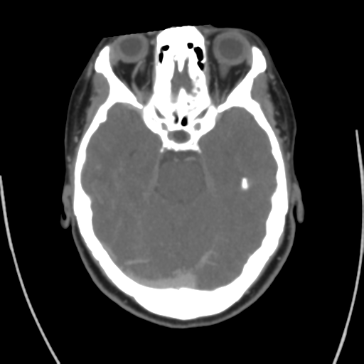 Cerebral venous infarct related to dural venous sinus thromboses (Radiopaedia 35292-36804 Axial C+ delayed 18).png