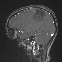 Cerebral venous infarction - hemorrhagic (Radiopaedia 81625-95505 Sagittal MRV 26).jpg