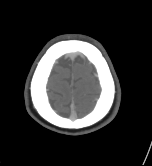 Cerebral venous infarction due to transverse sinus thrombosis (Radiopaedia 34688-36120 Axial CT venogram 45).png