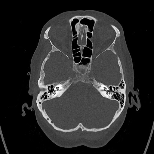 Cerebral venous infarction with hemorrhage (Radiopaedia 65343-74381 Axial bone window 27).jpg