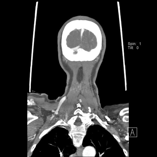 Cerebral venous infarction with hemorrhage (Radiopaedia 65343-74396 B 250).jpg
