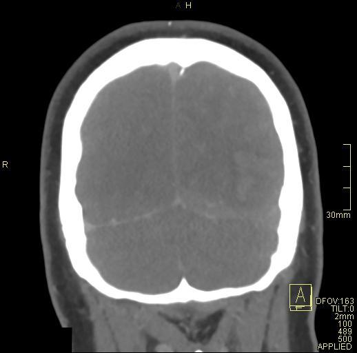 File:Cerebral venous sinus thrombosis (Radiopaedia 91329-108965 Coronal venogram 75).jpg