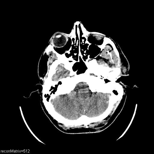 File:Cerebral venous thrombosis (Radiopaedia 29426).jpg