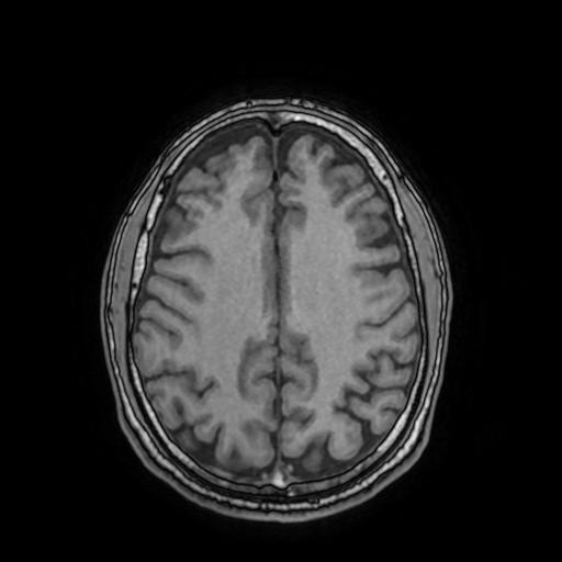 Cerebral venous thrombosis with secondary intracranial hypertension (Radiopaedia 89842-106957 Axial T1 120).jpg