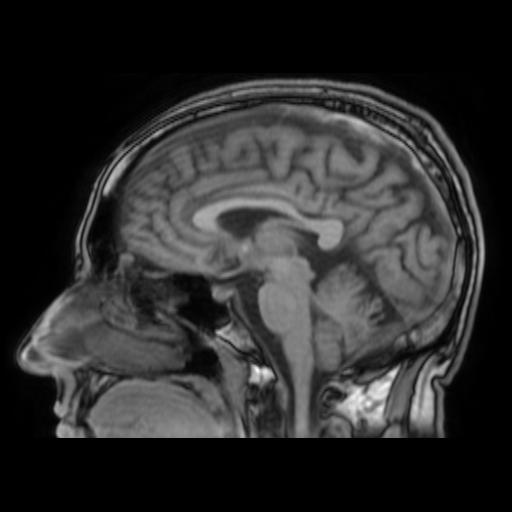 File:Cerebral venous thrombosis with secondary intracranial hypertension (Radiopaedia 89842-106957 Sagittal T1 15).jpg