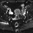 File:Cervical adenocarcinoma (Radiopaedia 65011-73985 Axial DWI 52).jpg