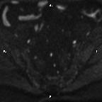 Cervical adenocarcinoma (Radiopaedia 65011-73985 Axial DWI 80).jpg