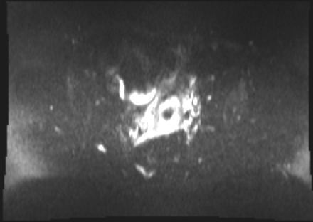 File:Cervical carcinoma (Radiopaedia 88312-104943 Axial DWI 11).jpg