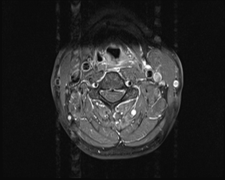 File:Cervical disc extrusion (Radiopaedia 53950-60077 Axial T1 C+ fat sat 10).jpg