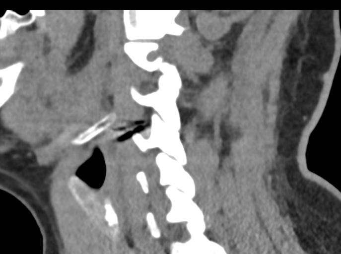 Cervical disc replacement (Radiopaedia 44025-47541 B 36).png