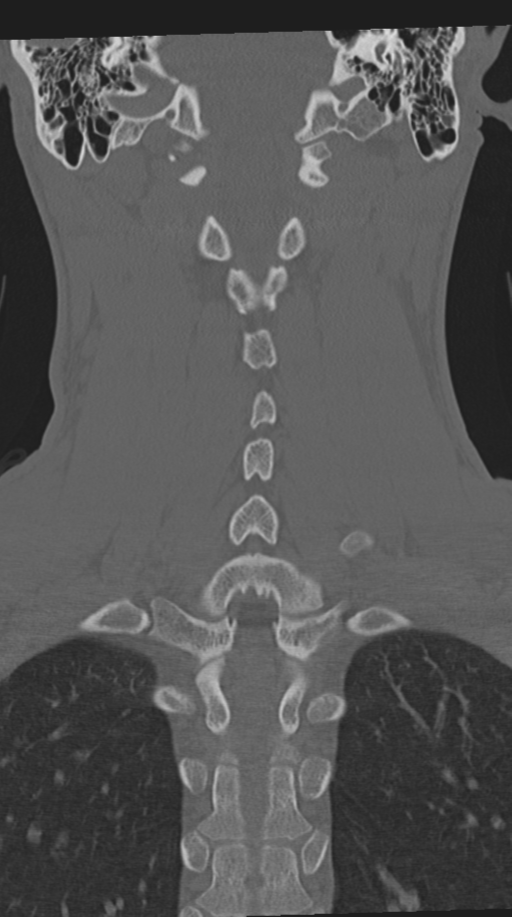 Cervical intercalary bone (Radiopaedia 35211-36748 Coronal bone window 50).png