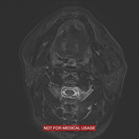 File:Cervical nerve schwannoma (Radiopaedia 27964-28221 C 23).jpg
