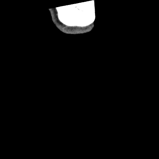 Cervical schwannoma (Radiopaedia 57979-64974 G 69).png