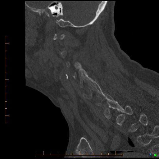 Cervical spine fracture - ankylosing spondylitis (Radiopaedia 76835-88706 Sagittal bone window 32).jpg