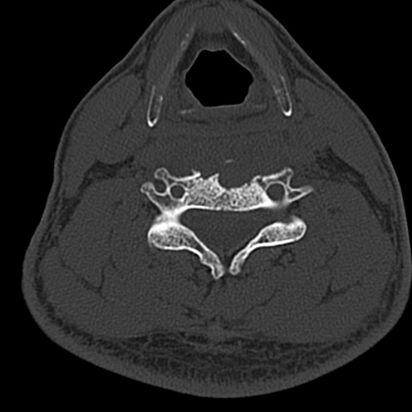 Cervical spondylodiscitis (Radiopaedia 28057-29489 Axial bone window 47).jpg