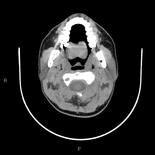 File:Cervical thymic cyst (Radiopaedia 88632-105335 Axial non-contrast 88).jpg