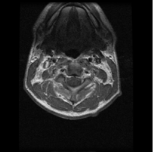 File:Cervical vertebrae metastasis (Radiopaedia 78814-91667 Axial T1 C+ 19).png