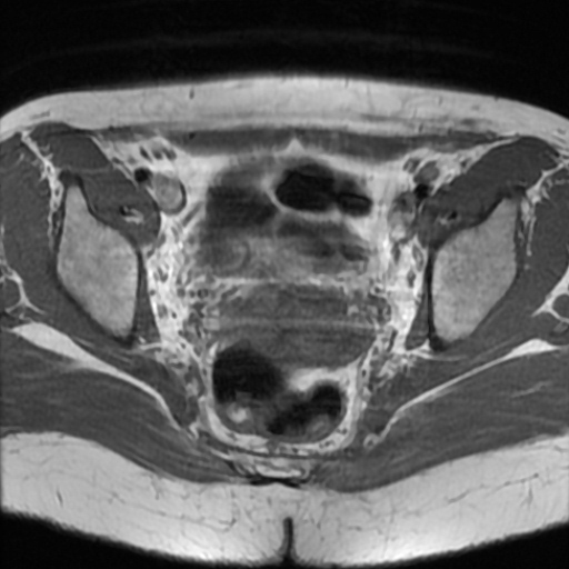 File:Cesarian section scar endometriosis (Radiopaedia 66520-75799 Axial T1 13).jpg