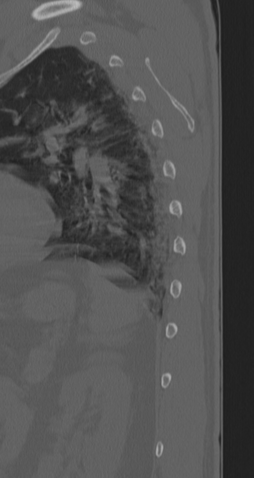 Chance fracture (Radiopaedia 33854-35020 Sagittal bone window 5).png
