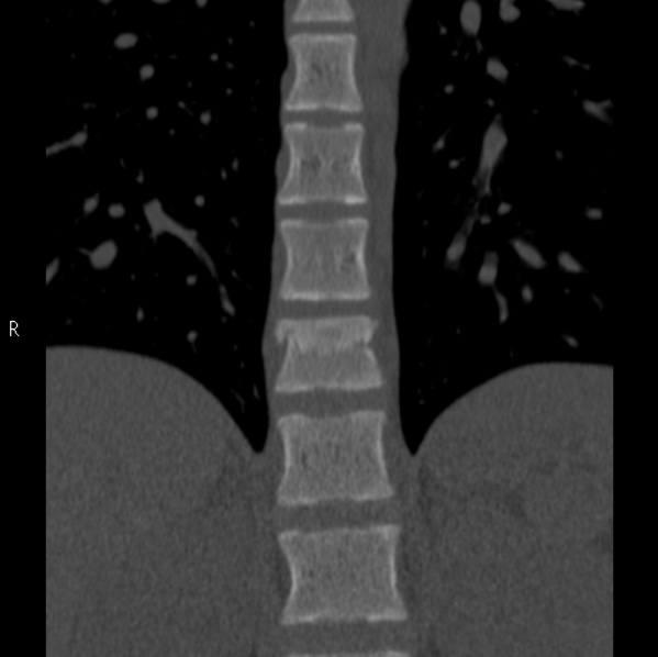 File:Chance fracture (Radiopaedia 36521-38081 Coronal bone window 10).jpg