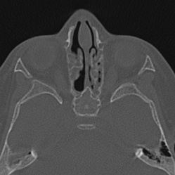 Choanal atresia (Radiopaedia 88525-105975 Axial bone window 63).jpg