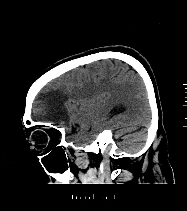 Cholangiocarcinoma with cerebral metastases (Radiopaedia 83519-98628 C 40).jpg