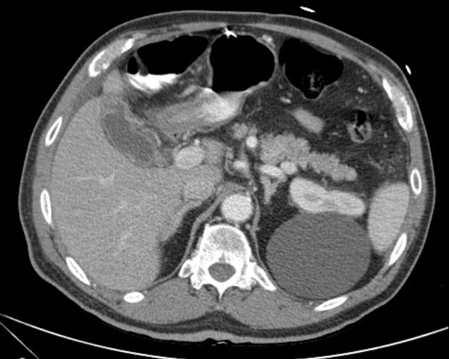 Cholecystitis - perforated gallbladder (Radiopaedia 57038-63916 A 26).jpg