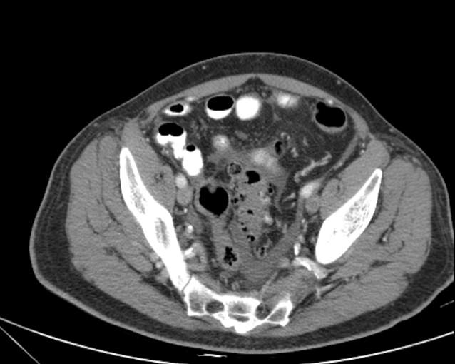 File:Cholecystitis - perforated gallbladder (Radiopaedia 57038-63916 A 69).jpg