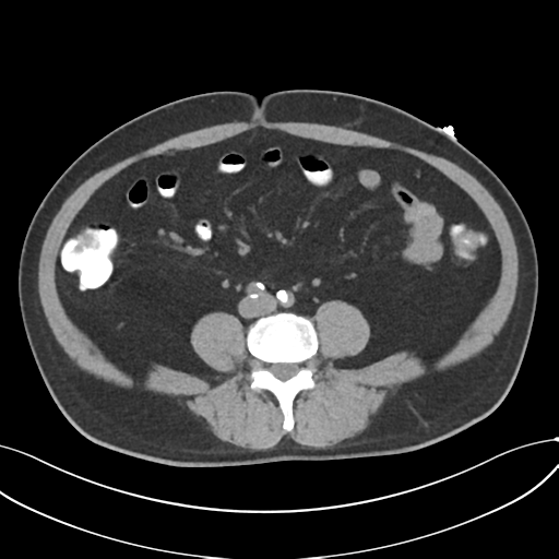 File:Cholecystitis with focal perforation and hepatic abscess (Radiopaedia 37189-38945 Axial non-contrast 52).png