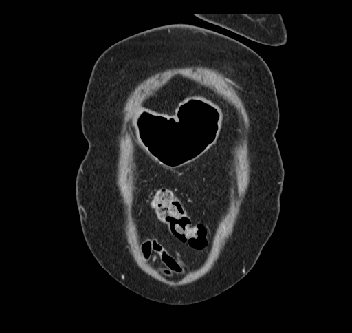 Cholecystoduodenal fistula (Radiopaedia 48959-54022 B 22).jpg