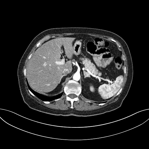 Cholecystoduodenal fistula due to calculous cholecystitis with gallstone migration (Radiopaedia 86875-103077 A 20).jpg