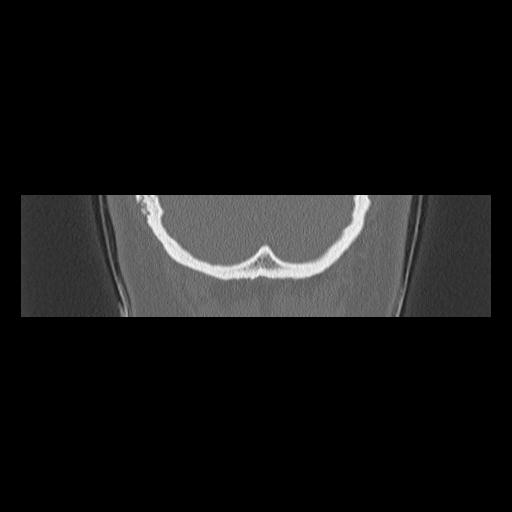 Cholesteatoma (Radiopaedia 84946-100455 Coronal bone window 155).jpg
