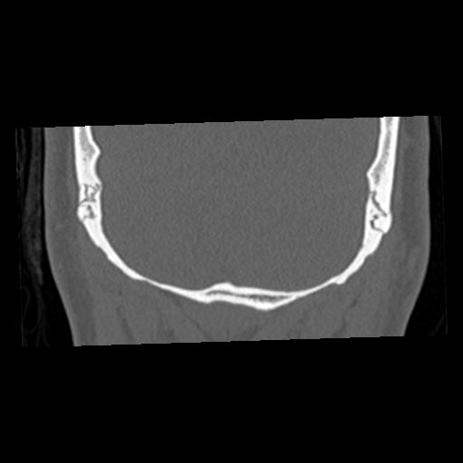 Cholesteatoma (Radiopaedia 84960-100474 Coronal bone window 74).jpg