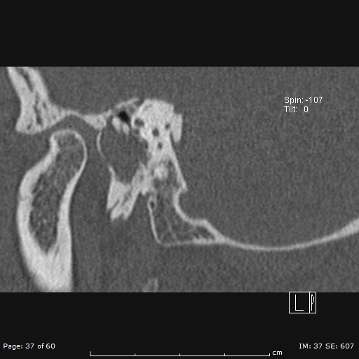 Cholesteatoma - external auditory canal (Radiopaedia 88452-105096 Sagittal bone window 37).jpg