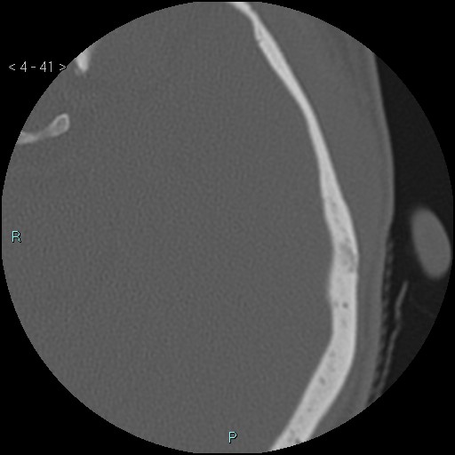 File:Cholesterol granuloma of the petrous apex (Radiopaedia 64358-73141 Axial bone window 20).jpg