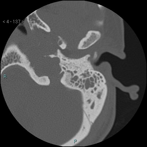 File:Cholesterol granuloma of the petrous apex (Radiopaedia 64358-73141 Axial bone window 66).jpg