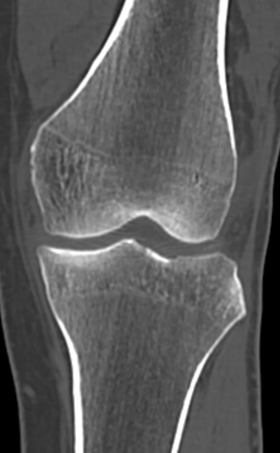 Chondrocalcinosis (Radiopaedia 82862-97173 Coronal bone window 37).jpg