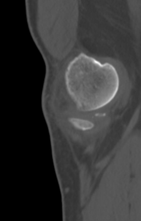 Chondrocalcinosis (Radiopaedia 82862-97173 Sagittal bone window 5).jpg