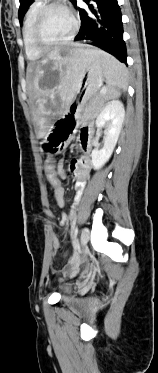 Choriocarcinoma liver metastases (Radiopaedia 74768-85766 C 77).jpg