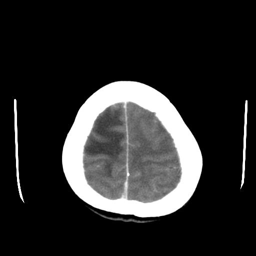 File:Choriocarcinoma of ovary with cerebral and pulmonary metastases (Radiopaedia 25983-26118 A 23).jpg