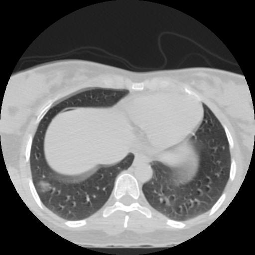 File:Choriocarcinoma of ovary with cerebral and pulmonary metastases (Radiopaedia 25983-26119 Axial lung window 23).jpg