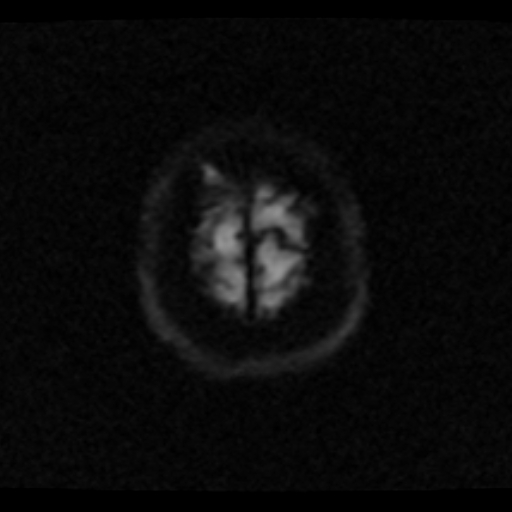 File:Choroid plexus xanthogranuloma (Radiopaedia 17650-17386 DWI 1).jpg