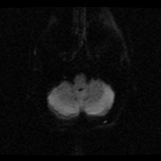 File:Choroid plexus xanthogranuloma (Radiopaedia 17650-17386 DWI 20).jpg
