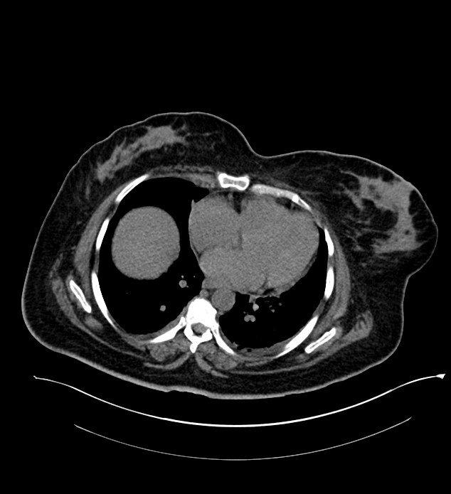 Chromophobe renal cell carcinoma (Radiopaedia 84239-99519 Axial non-contrast 15).jpg