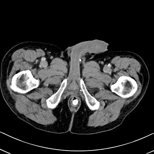 Chronic appendicitis complicated by appendicular abscess, pylephlebitis and liver abscess (Radiopaedia 54483-60700 B 158).jpg