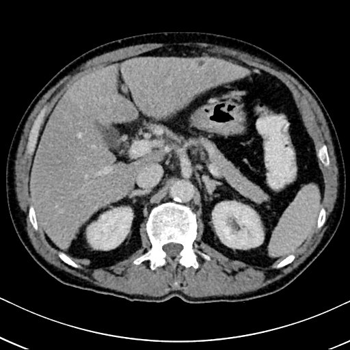 Chronic appendicitis complicated by appendicular abscess, pylephlebitis and liver abscess (Radiopaedia 54483-60700 B 51).jpg